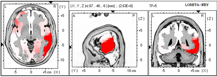 LORETA analysis at 5 Hz
